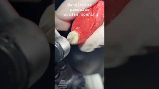 Premolar Access Opening – Quick Dental Tutorial #viral #viralshorts