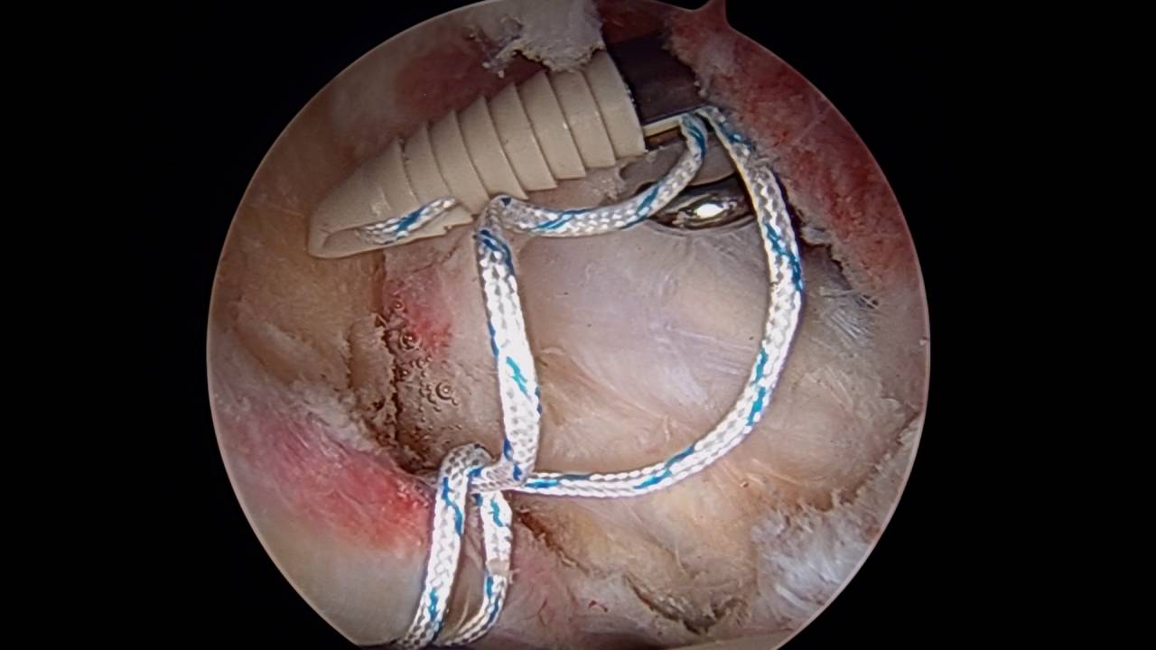My hip repair labral tear YouTube