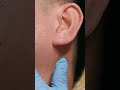 #trying #wartstreatment #warts #removal #shorts