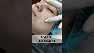 TCA Peel Treatment  #skintreatment #facial #cosmeticprocedure