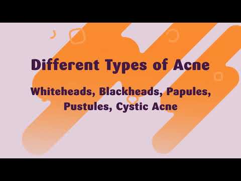 Different Types of Acne and Treatments