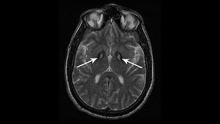 NBIA(Neurodegeneration with Brain Iron Accumulation ) NBIA(Neurodegeneration with Brain Iron Accumulation )