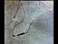IVUS Guidance PCI Using Drug Elution Balloon for RCA CTO