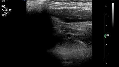 USG GUIDED TRIGEMINAL V3 BLOCK