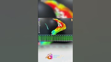 3D Mapping and Radiofrequency Ablation #shorts