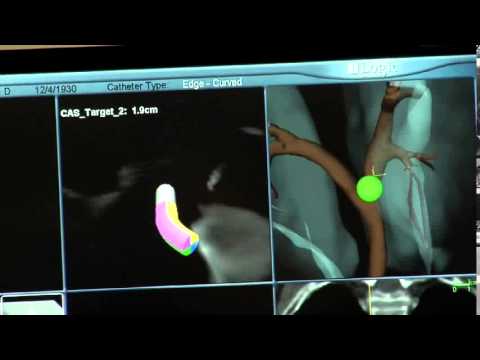 Video: Bronchoscopy: Procedure, Risici Og Bedring