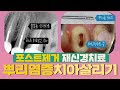 치아살리기 뿌리염증 포스트제거 재신경치료ㅣ 잘못된 신경치료