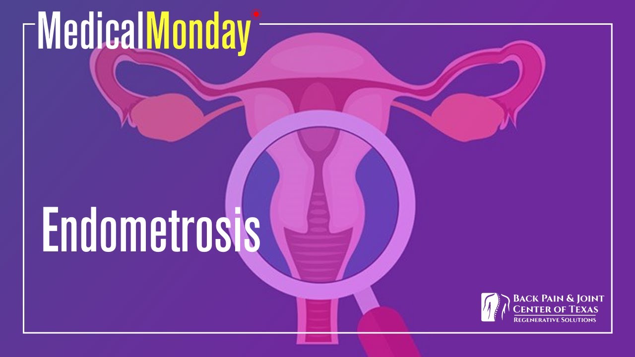 Medical Monday: Endometriosis