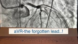 Avr-The Forgotten Ekg Lead In Acs.left Main Lm 90% Ostial Calcified Lesion. Ivl Lithotripsy Pci.