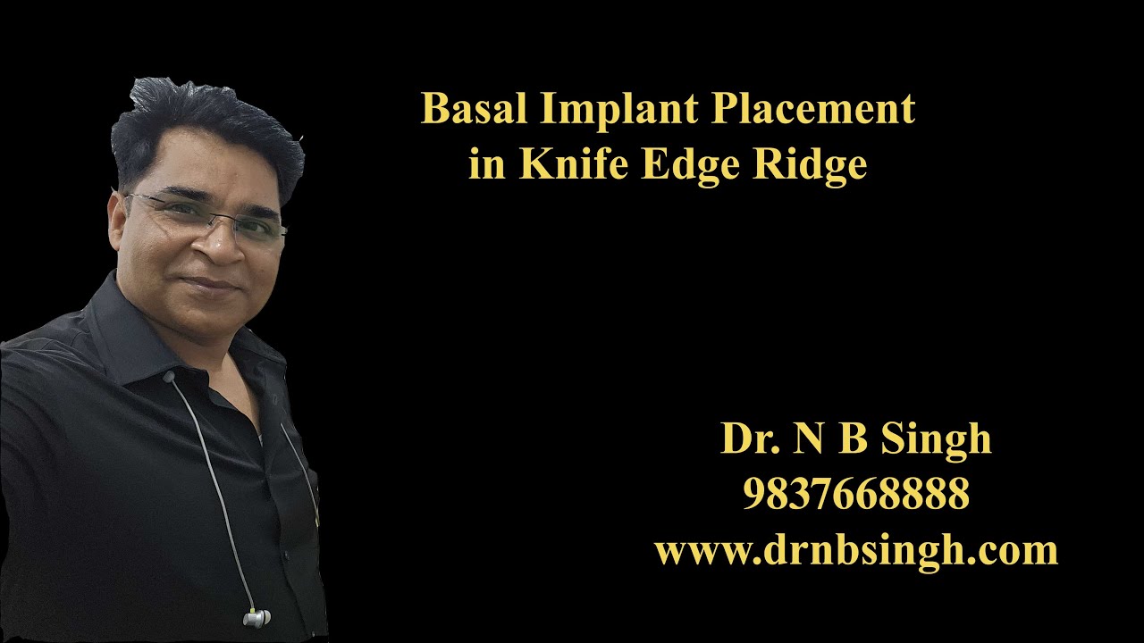 basal implant placement in knife edge ridge - Dr NBsingh.mp4 - YouTube