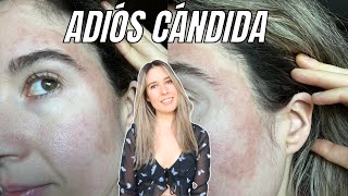 LOS SÍNTOMAS QUE ME PROVOCÓ LA CANDIDIASIS, PARÁSITOS, DERMATITIS + Mi nuevo programa de limpieza