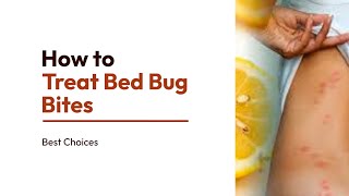 12 Easy Steps to Treat Bed Bug Bites | How to Treat Bed Bug Bites | Best choices