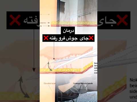 درمان فرورفتگی جوش اسکار آکنه آبله زخم