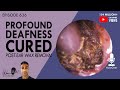 636 - Profound Deafness Cured Post Ear Wax Removal