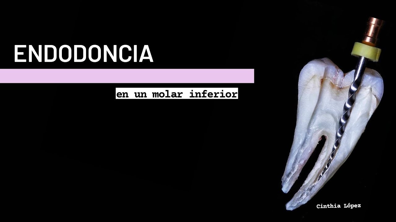 Endodoncia 1er Molar inferior