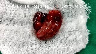 Live Haemorrhoidectomy || Grade 3 Internal Piles || Harmonic Scalpel Colorectal Surgery