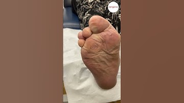 Removing painful corn with scalpel