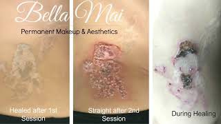 Salt and Saline Body Tattoo Removal 2 Treatments and Healing Process        (HIGHLY ASKED FOR VIDEO)