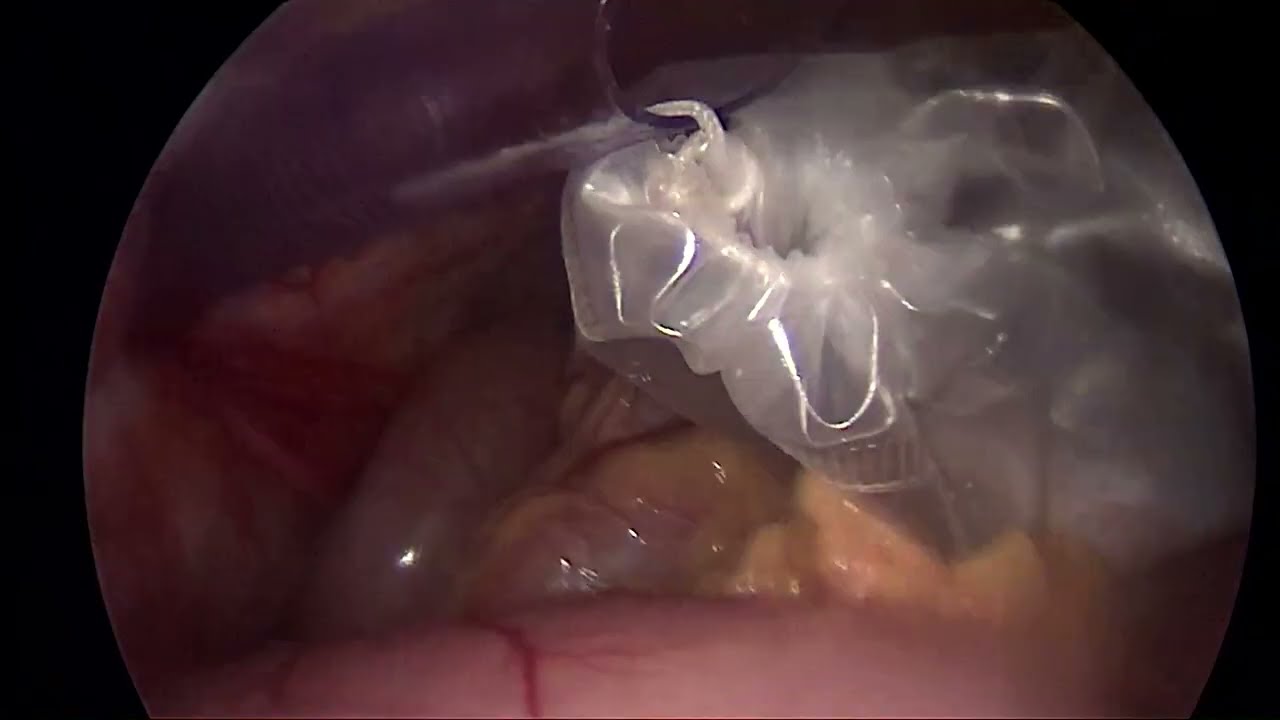 Laparoscopic Cholecystectomy: Achieving the Critical View of Safety (CVS)