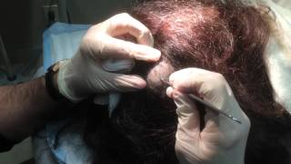 Pilar Cyst Removal On The Scalp