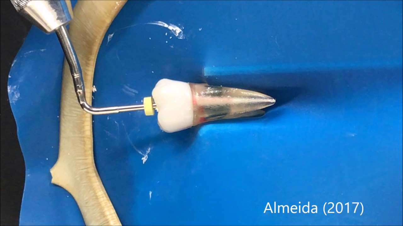 Técnica de Ondas Contínuas de Obturação 2