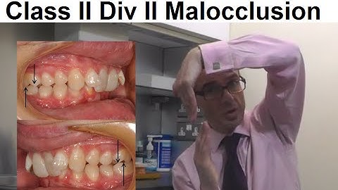 Why Class II Division II Malocclusion/ Inclined Teeth is Less Common in People by Dr Mike Mew