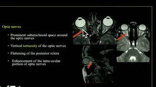 TMT: CSF FLOW PART III: SPONTANEOUS INTRA CRANIAL HYPERTENSION