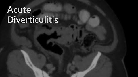 Abdominal case review - Acute diverticulitis