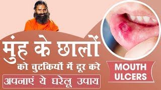 मुंह के छालों (Mouth ulcers) को चुटकियों में दूर करे अपनाएं ये घरेलू उपाय | Swami Ramdev