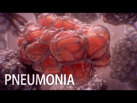 Pneumonia and the pivotal role of alveoli | medical animation
