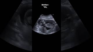 Baby and mother talking in the womb |love shortsvideo babies youtubeshorts drpoonammaggo