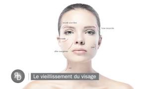 Les Fils Tenseurs - Explication Dr Diacakis