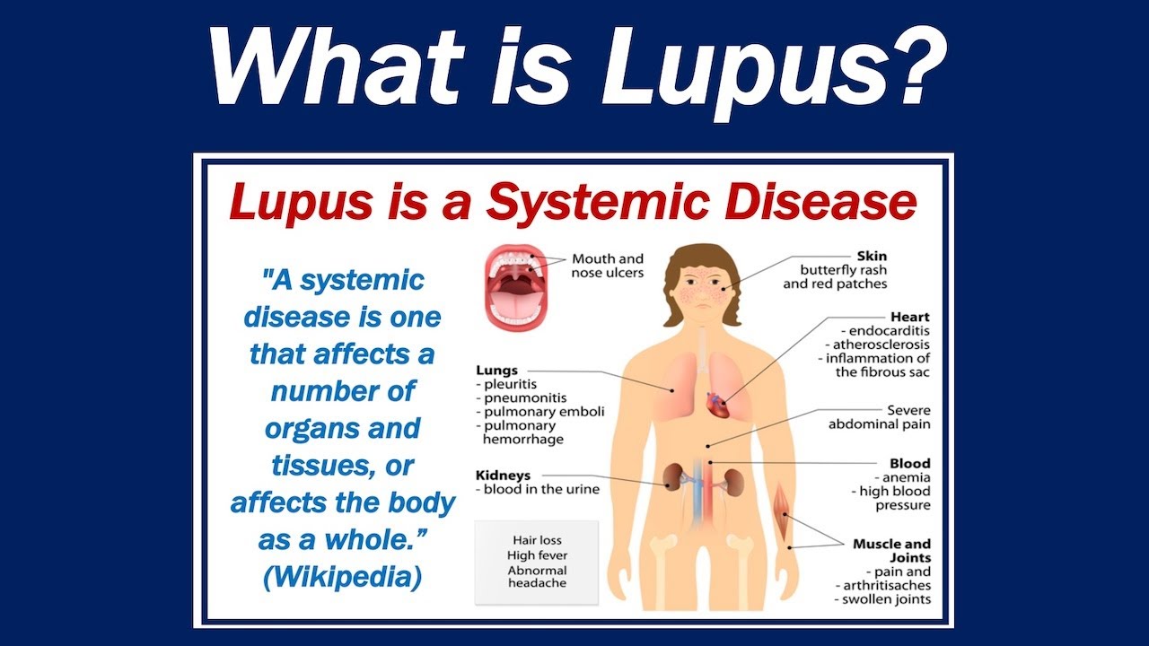 lupus headaches