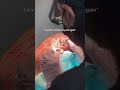 No scalpel, No staples, No linear scar — just your own hair, growing back naturally; NeoGraft FUE