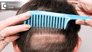 At what age does hair loss start? - Dr. Rasya Dixit