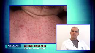 Uzm.Dr. Faruk Fidan,Altıncı Hastalık,Medicabil