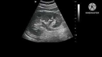 Ureterovesical stone on ultrasound
