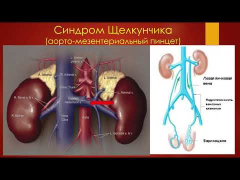 Варикоцеле. УЗ-диагностика. Ультразвук в руках уролога - 2021.