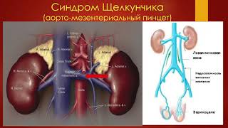 Варикоцеле. УЗ-диагностика. Ультразвук в руках уролога - 2021.