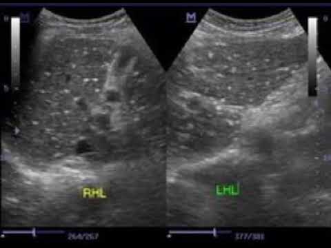 Case Discussion 006 starry sky appearance on ultrasound