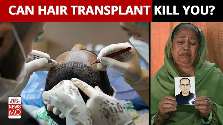 Can You Die Of Hair Transplant Surgery? Doctors Explain - DayDayNews