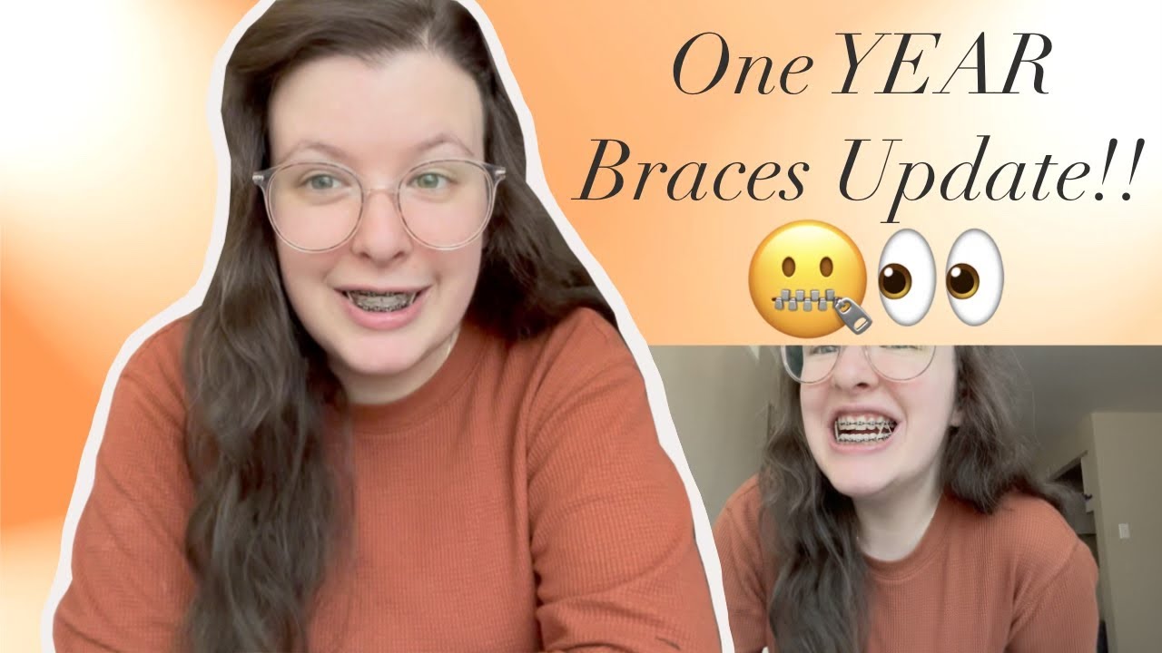 1-year-braces-update-youtube