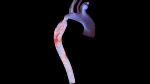 Image-based blood flow modeling in an aortic coarctation