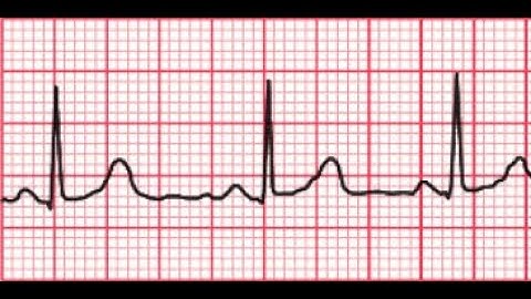 Analisis de señales ECG por medio del algoritmo pan-tompkins