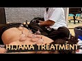 CUPPING TREATMENT | HIJAMA TREATMENT