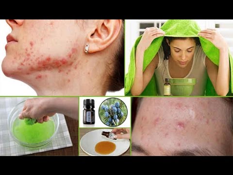  Cystic Acne Home Remedies that Really Work | Health Vlogger