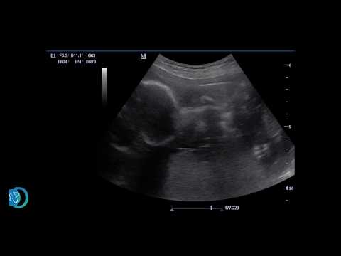 ჭიპლარის ბიპოლარული კოაგულაცია / BIPOLAR CORD COAGULATION