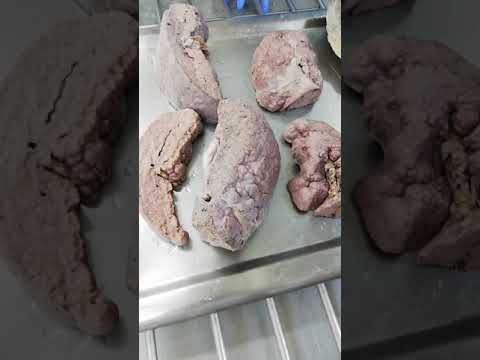 Cirrosis macronodular