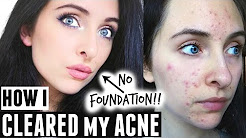 HOW I CLEARED MY SKIN & MARKS | MY ACNE STORY + PRODUCTS