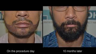 Best Beard Transplant Clinic - DHI Direct Technique